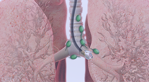 Banner Endobronchial Ultrasound (EBUS)